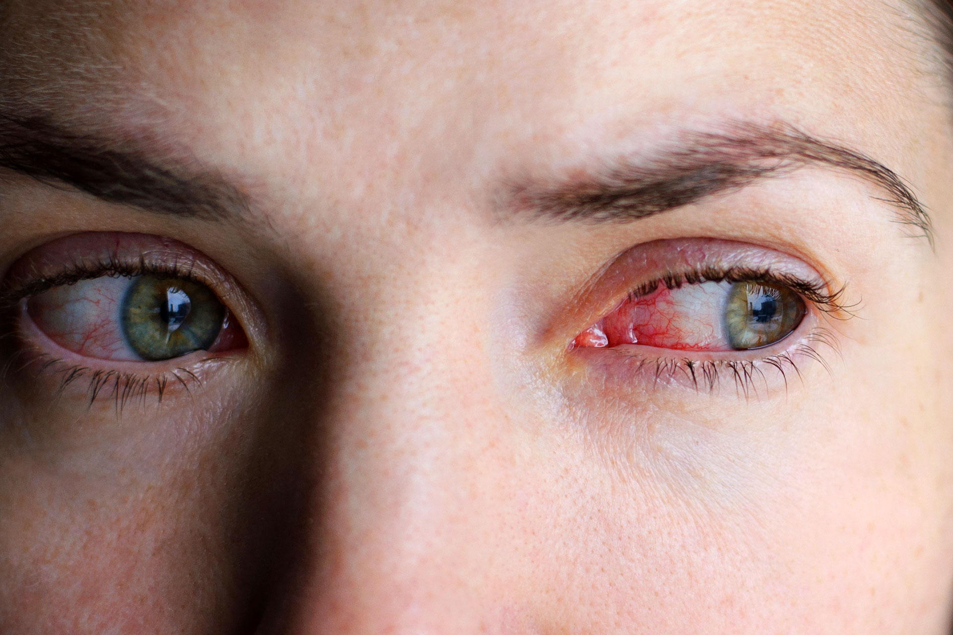 swollen-eyes-dark-circles-red-and-burning-eyes